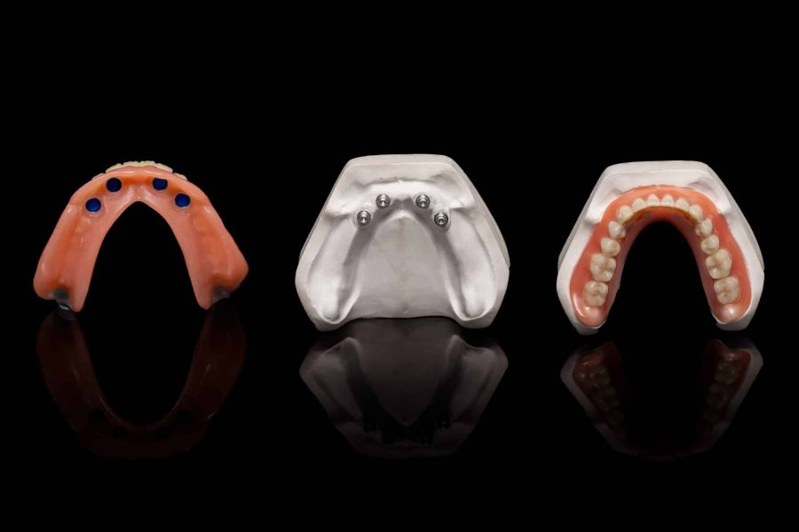 Verschiedene Modelle implantatgetragener Zahnprothesen im Vergleich